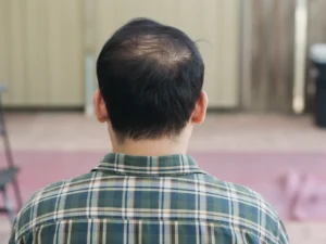 탈모 원인과 예방방법